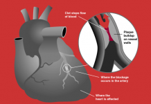 Heart Attack – The commonest killer disease in India