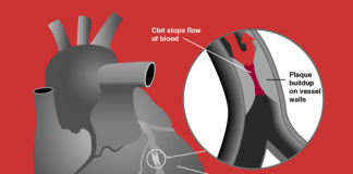 Heart Attack – The commonest killer disease in India