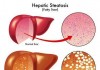 Cure Fatty Liver Disease the Ayurveda way