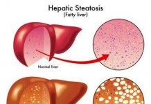 Cure Fatty Liver Disease the Ayurveda way