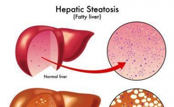 Cure Fatty Liver Disease the Ayurveda way