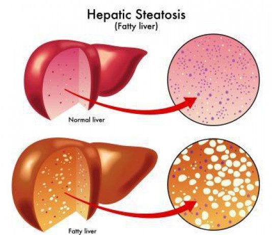 Cure Fatty Liver Disease the Ayurveda way